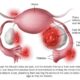 Serrapeptase: Ultimate Natural Treatment for Endometriosis?