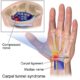 Severe carpal tunnel pain relief
